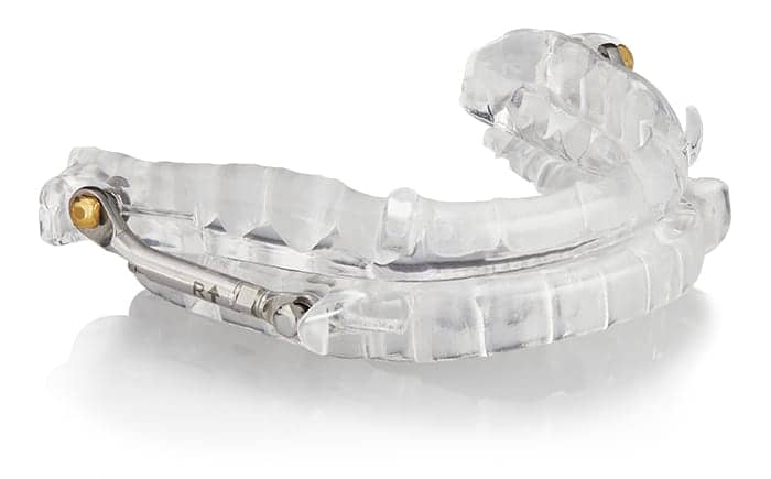 Custom oral appliance device used for sleep apnea treatment